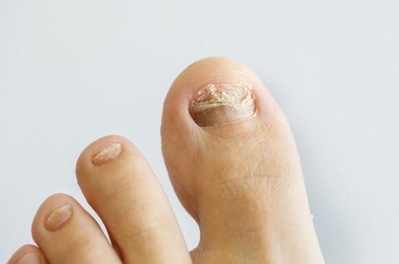 Nagelpilz