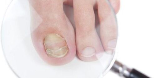 Pilzdiagnose