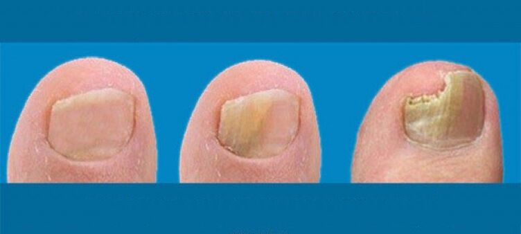 Entwicklungsprozess für Nagelpilz