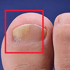 Mykose oder Nagelpilz