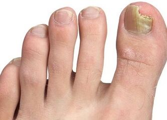 Nagelpilzsymptome