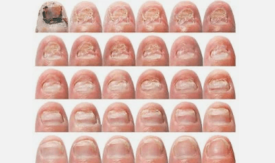 Wie sehen Sie den Nagelpilz
