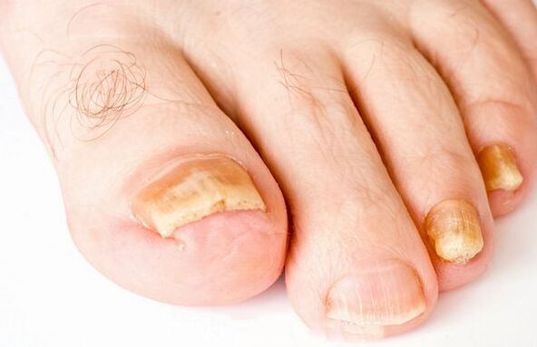 Nagelpilz