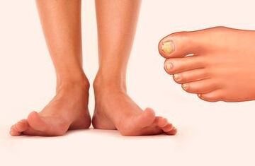 Nagelpilz