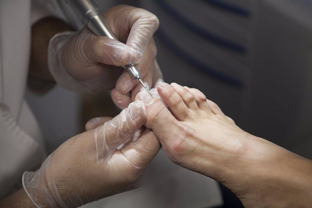 Professionelle Nagelpilzbehandlung