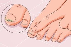 Nagelpilzinfektion